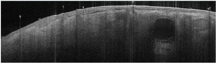 VivoSight OCT-Querschnitt einer Hautläsion